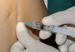 Holenderskie bóle porodowe